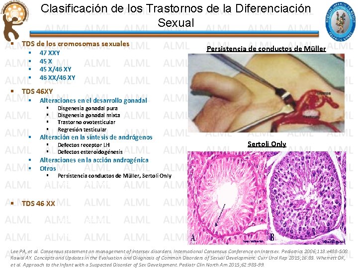 Clasificación de los Trastornos de la Diferenciación Sexual § TDS de los cromosomas sexuales Clasificación de los Trastornos de la Diferenciación Sexual § TDS de los cromosomas sexuales