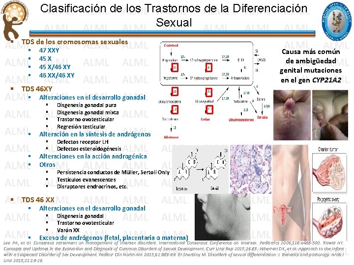 Clasificación de los Trastornos de la Diferenciación Sexual § TDS de los cromosomas sexuales Clasificación de los Trastornos de la Diferenciación Sexual § TDS de los cromosomas sexuales