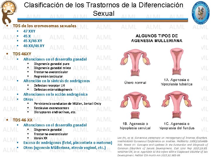 Clasificación de los Trastornos de la Diferenciación Sexual § TDS de los cromosomas sexuales Clasificación de los Trastornos de la Diferenciación Sexual § TDS de los cromosomas sexuales