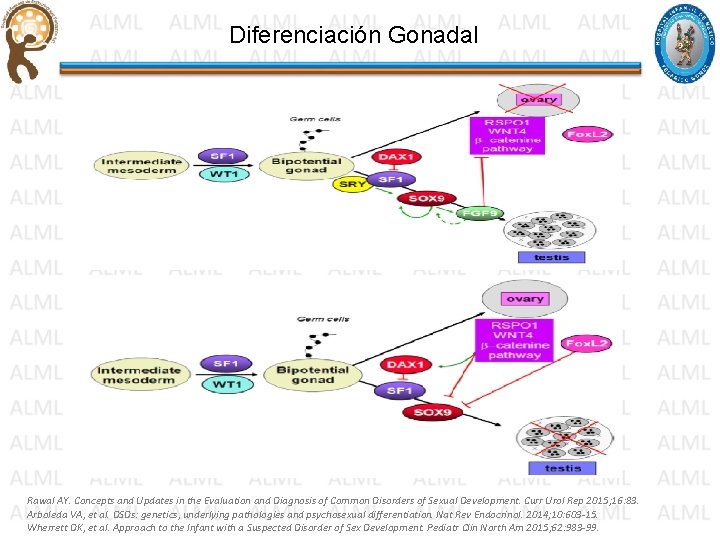 Diferenciación Gonadal Rawal AY. Concepts and Updates in the Evaluation and Diagnosis of Common Diferenciación Gonadal Rawal AY. Concepts and Updates in the Evaluation and Diagnosis of Common
