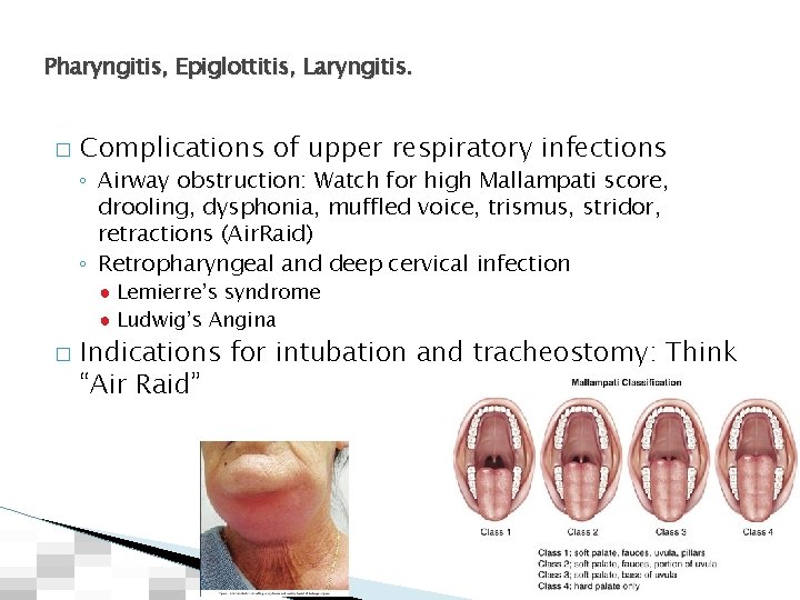 Pharyngitis, Epiglottitis, Laryngitis. � Complications of upper respiratory infections ◦ Airway obstruction: Watch for