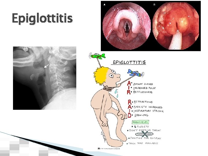 Epiglottitis 