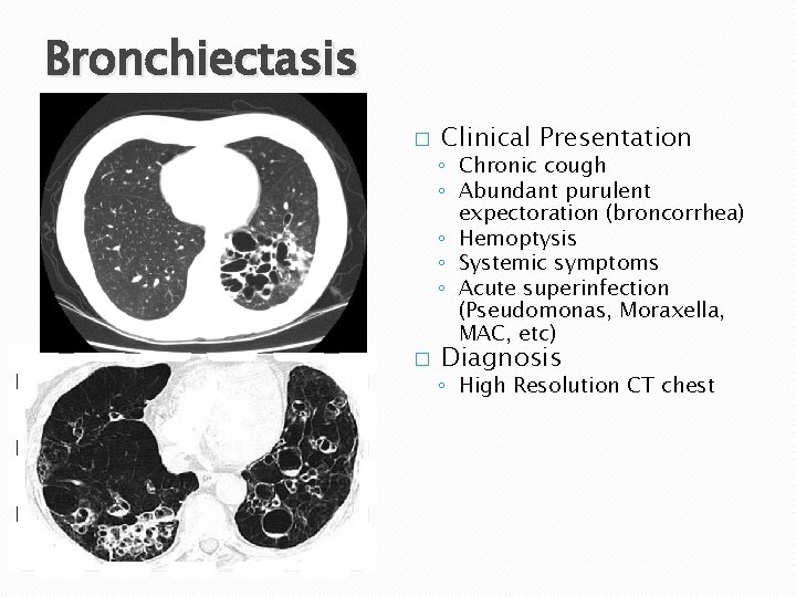 Bronchiectasis � Clinical Presentation ◦ Chronic cough ◦ Abundant purulent expectoration (broncorrhea) ◦ Hemoptysis