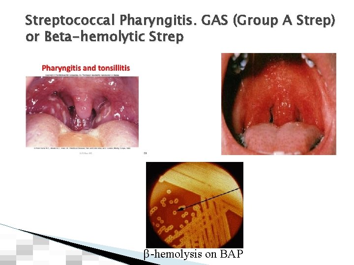 Streptococcal Pharyngitis. GAS (Group A Strep) or Beta-hemolytic Strep β-hemolysis on BAP 