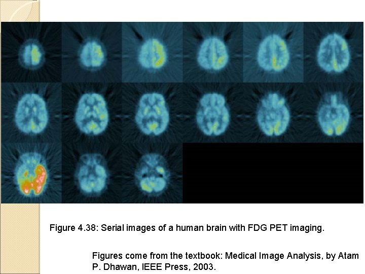 Figure 4. 38: Serial images of a human brain with FDG PET imaging. Figures