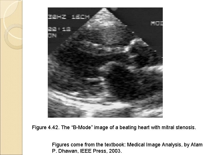 Figure 4. 42. The “B-Mode” image of a beating heart with mitral stenosis. Figures Figure 4. 42. The “B-Mode” image of a beating heart with mitral stenosis. Figures