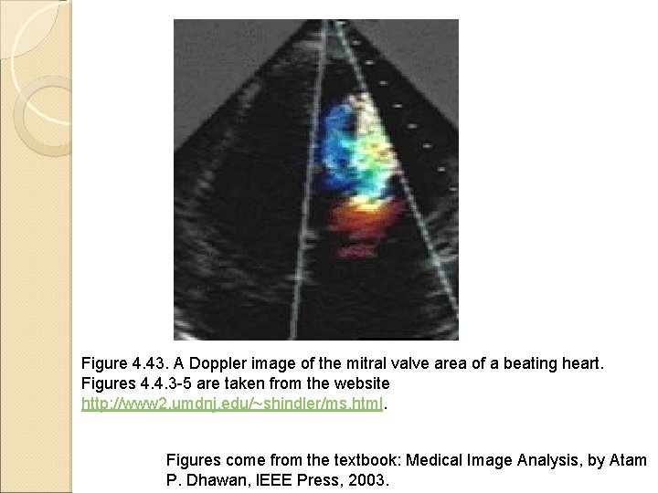 Figure 4. 43. A Doppler image of the mitral valve area of a beating