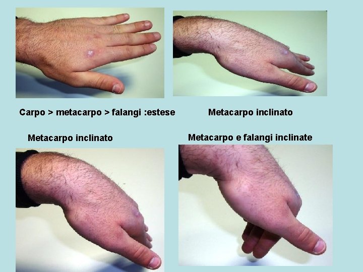 Carpo > metacarpo > falangi : estese Metacarpo inclinato Metacarpo e falangi inclinate 