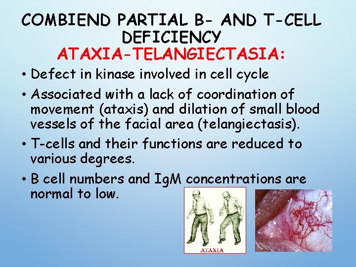 COMBIEND PARTIAL B- AND T-CELL DEFICIENCY ATAXIA-TELANGIECTASIA: • Defect in kinase involved in cell