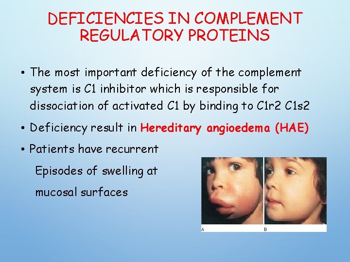 DEFICIENCIES IN COMPLEMENT REGULATORY PROTEINS • The most important deficiency of the complement system