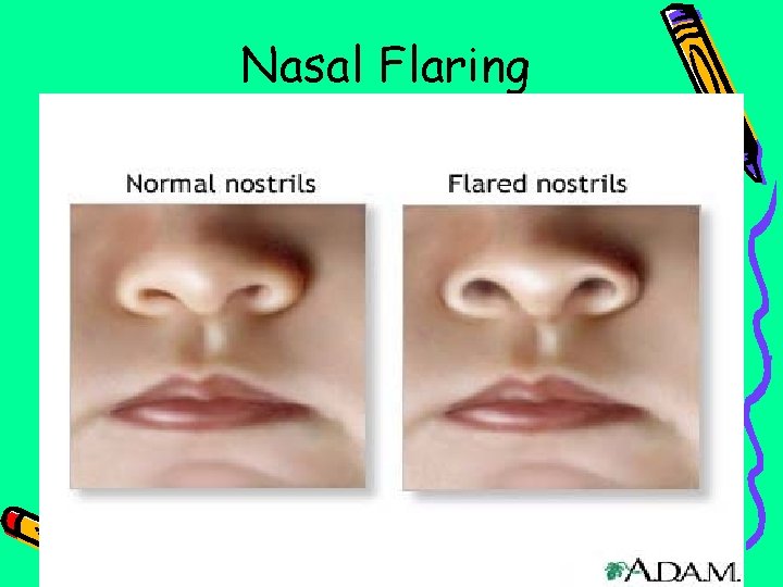 Nasal Flaring 