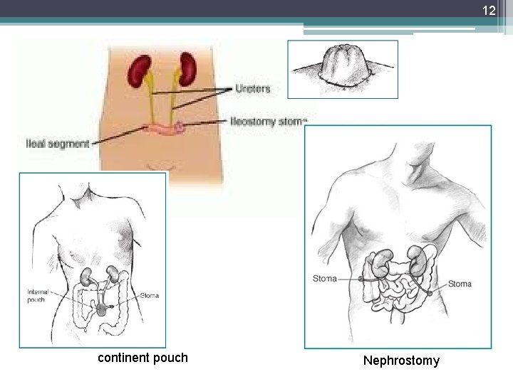 12 continent pouch Nephrostomy 