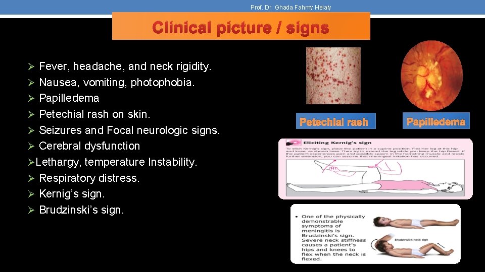 Prof. Dr. Ghada Fahmy Helaly Clinical picture / signs Ø Fever, headache, and neck