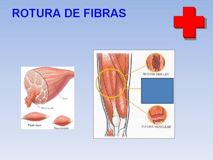 ROTURA DE FIBRAS 