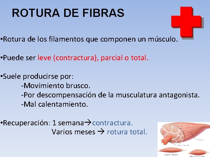 ROTURA DE FIBRAS • Rotura de los filamentos que componen un músculo. • Puede