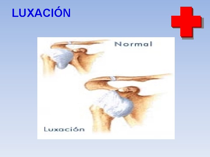 LUXACIÓN LUXACIÓN