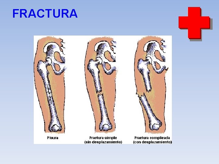 FRACTURA 