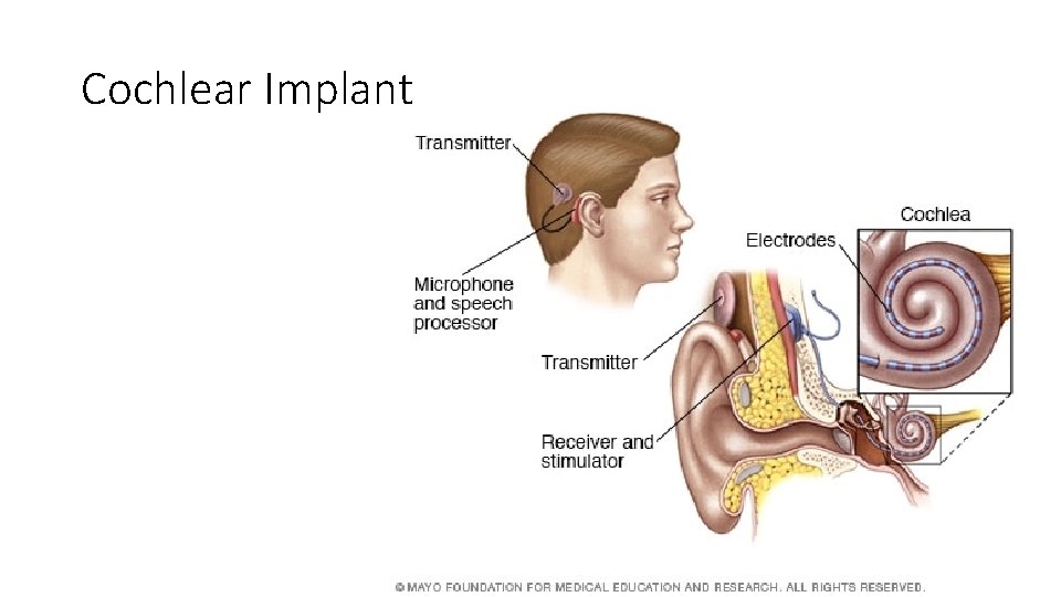 Cochlear Implant 