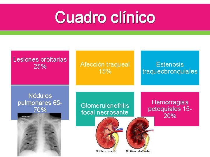 Cuadro clínico Lesiones orbitarias 25% Nódulos pulmonares 6570% Afección traqueal 15% Estenosis traqueobronquiales Glomerulonefritis