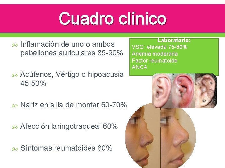 Cuadro clínico Inflamación de uno o ambos pabellones auriculares 85 -90% Acúfenos, Vértigo o