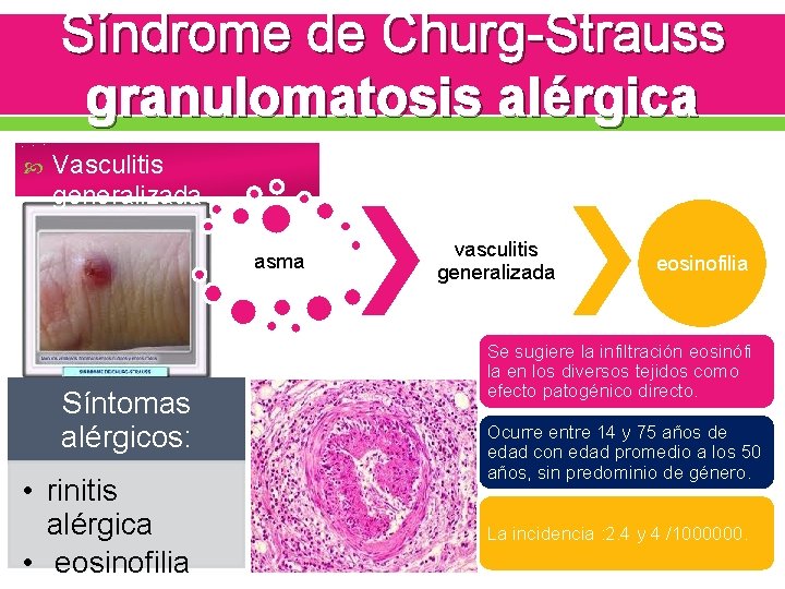 Síndrome de Churg-Strauss granulomatosis alérgica Vasculitis generalizada asma Síntomas alérgicos: • rinitis alérgica •