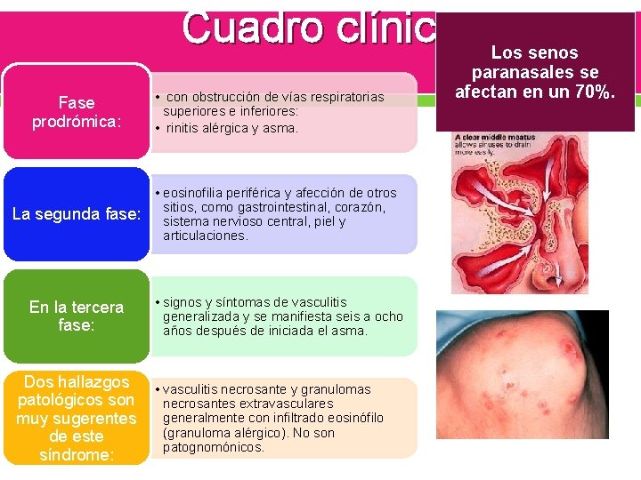 Cuadro clínico Fase prodrómica: • con obstrucción de vías respiratorias superiores e inferiores: •