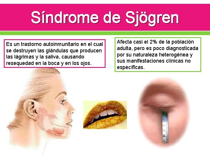 Síndrome de Sjögren Es un trastorno autoinmunitario en el cual se destruyen las glándulas