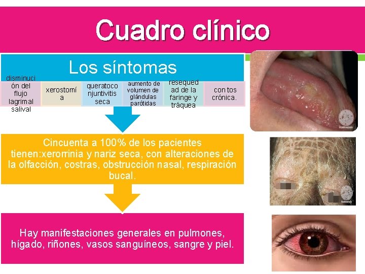 Cuadro clínico disminuci ón del flujo lagrimal salival Los síntomas xerostomí a queratoco njuntivitis