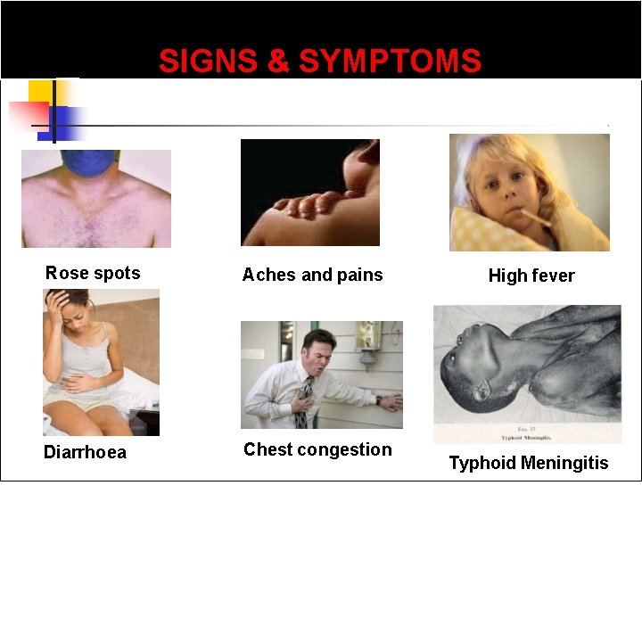 SIGNS & SYMPTOMS Rose spots Aches and pains Diarrhoea Chest congestion High fever Typhoid