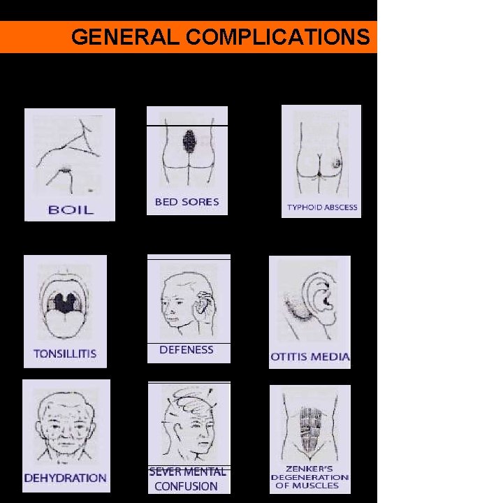 GENERAL COMPLICATIONS 