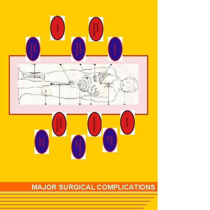 MAJOR SURGICAL COMPLICATIONS 