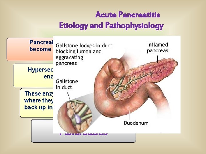 Acute Pancreatitis Etiology and Pathophysiology Pancreatic Ducts become obstructed Hypersecretion of the exocrine enzymes