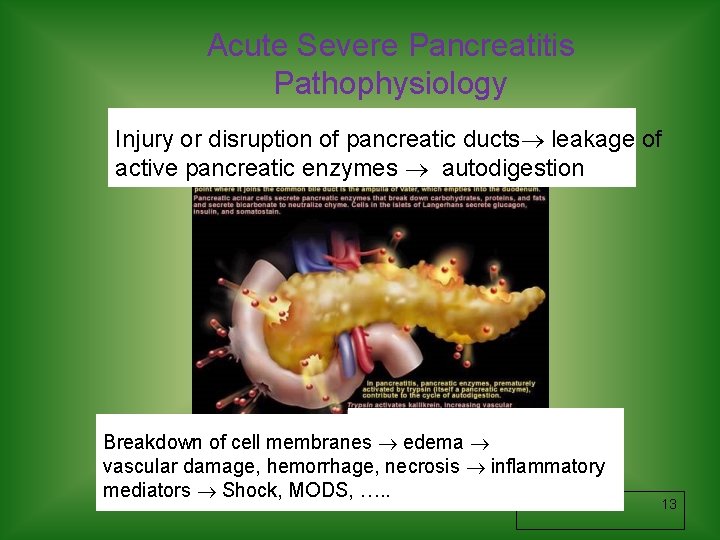 Acute Severe Pancreatitis Pathophysiology Injury or disruption of pancreatic ducts leakage of active pancreatic