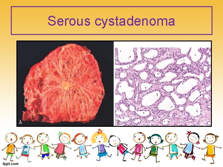 Serous cystadenoma 