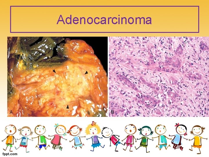 Adenocarcinoma 