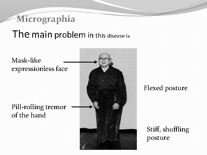 Micrographia The main problem in this disease is Mask-like expressionless face Flexed posture Pill-rolling