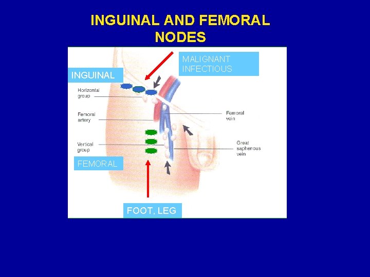 INGUINAL AND FEMORAL NODES MALIGNANT INFECTIOUS INGUINAL FEMORAL FOOT, LEG 