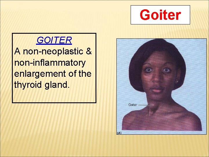 Goiter GOITER A non-neoplastic & non-inflammatory enlargement of the thyroid gland. 