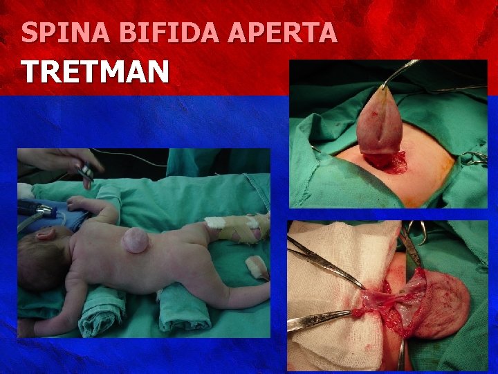 SPINA BIFIDA APERTA TRETMAN 