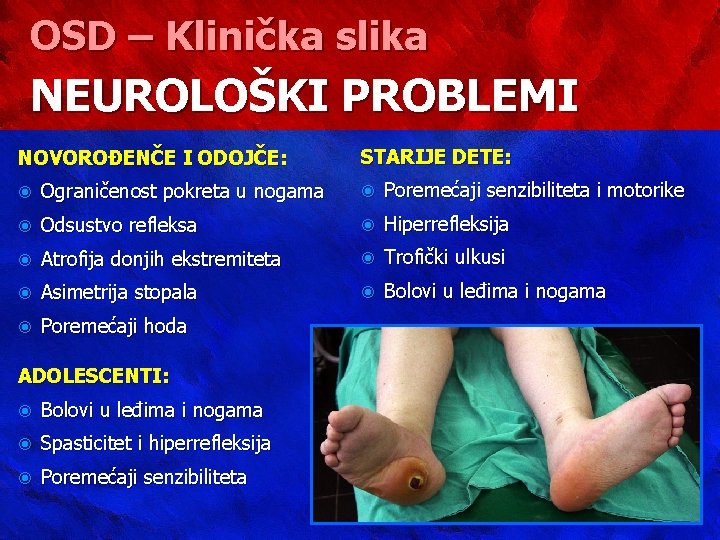 OSD – Klinička slika NEUROLOŠKI PROBLEMI NOVOROĐENČE I ODOJČE: STARIJE DETE: Ograničenost pokreta u