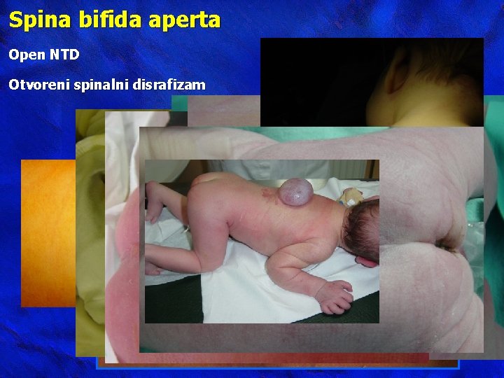 Spina bifida aperta Open NTD Otvoreni spinalni disrafizam 