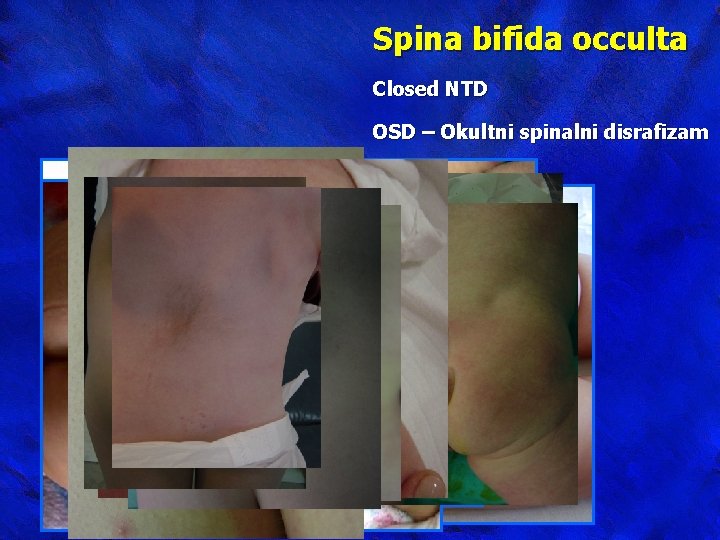 Spina bifida occulta Closed NTD OSD – Okultni spinalni disrafizam 