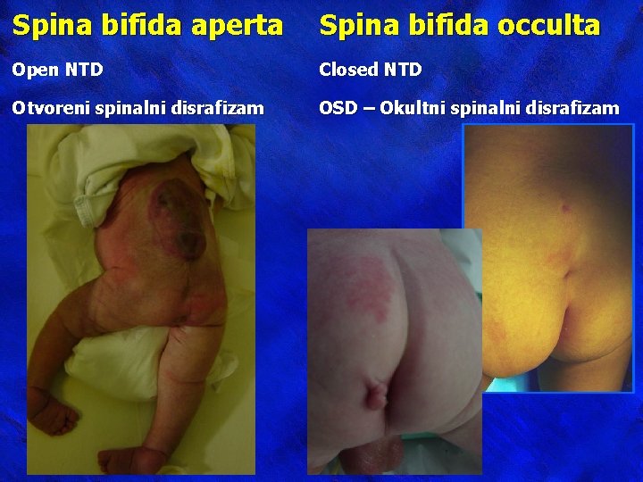 Spina bifida aperta Spina bifida occulta Open NTD Closed NTD Otvoreni spinalni disrafizam OSD