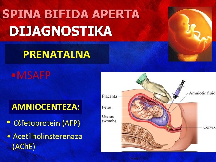 SPINA BIFIDA APERTA DIJAGNOSTIKA PRENATALNA • MSAFP AMNIOCENTEZA: • fetoprotein (AFP) • Acetilholinsterenaza (ACh.