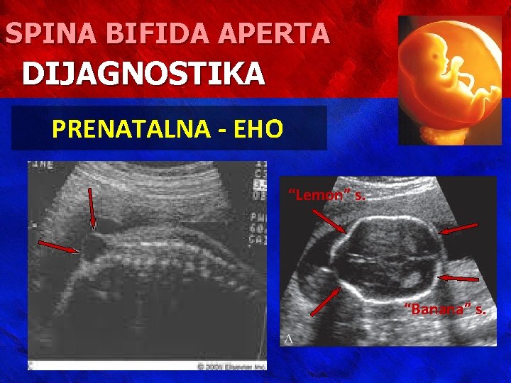 SPINA BIFIDA APERTA DIJAGNOSTIKA PRENATALNA - EHO “Lemon” s. “Banana” s. 