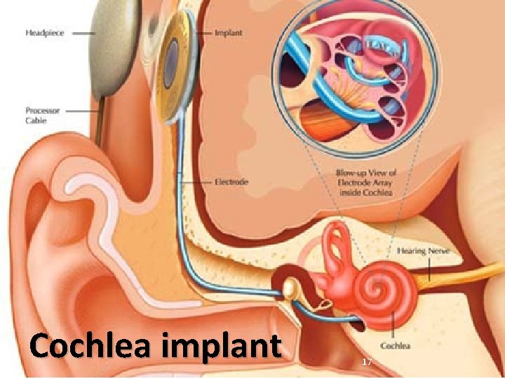 Cochlea implant 17 