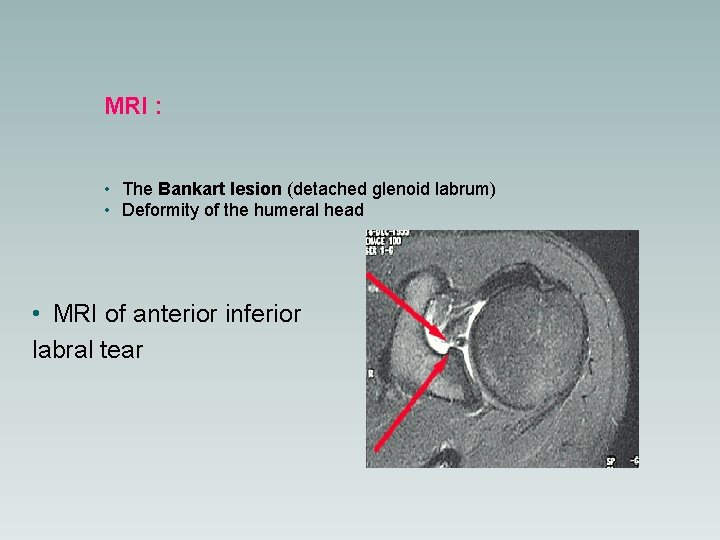 MRI : • The Bankart lesion (detached glenoid labrum) • Deformity of the humeral