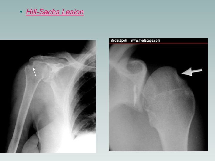  • Hill-Sachs Lesion 