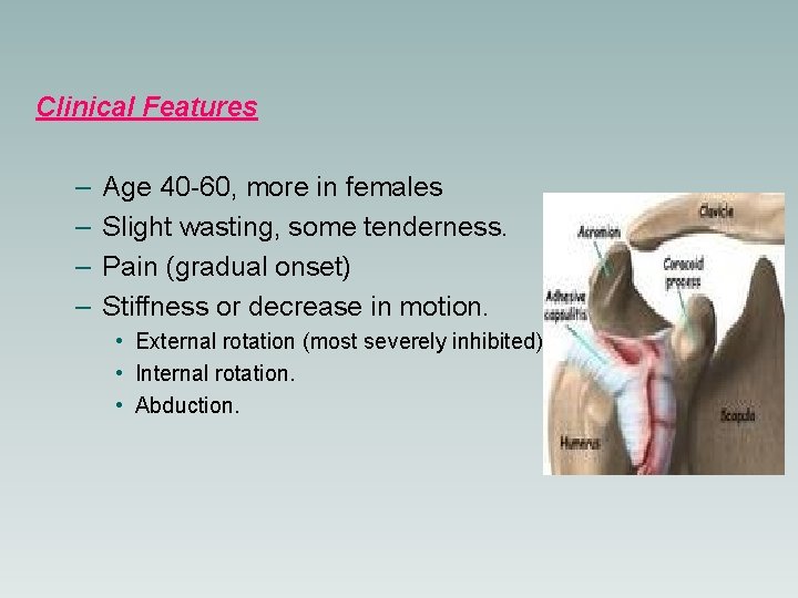 Clinical Features – – Age 40 -60, more in females Slight wasting, some tenderness.