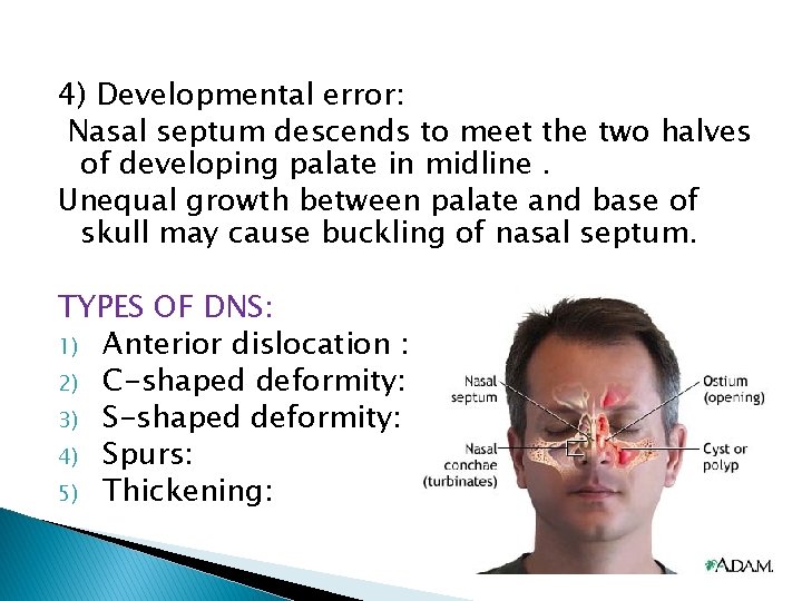 4) Developmental error: Nasal septum descends to meet the two halves of developing palate